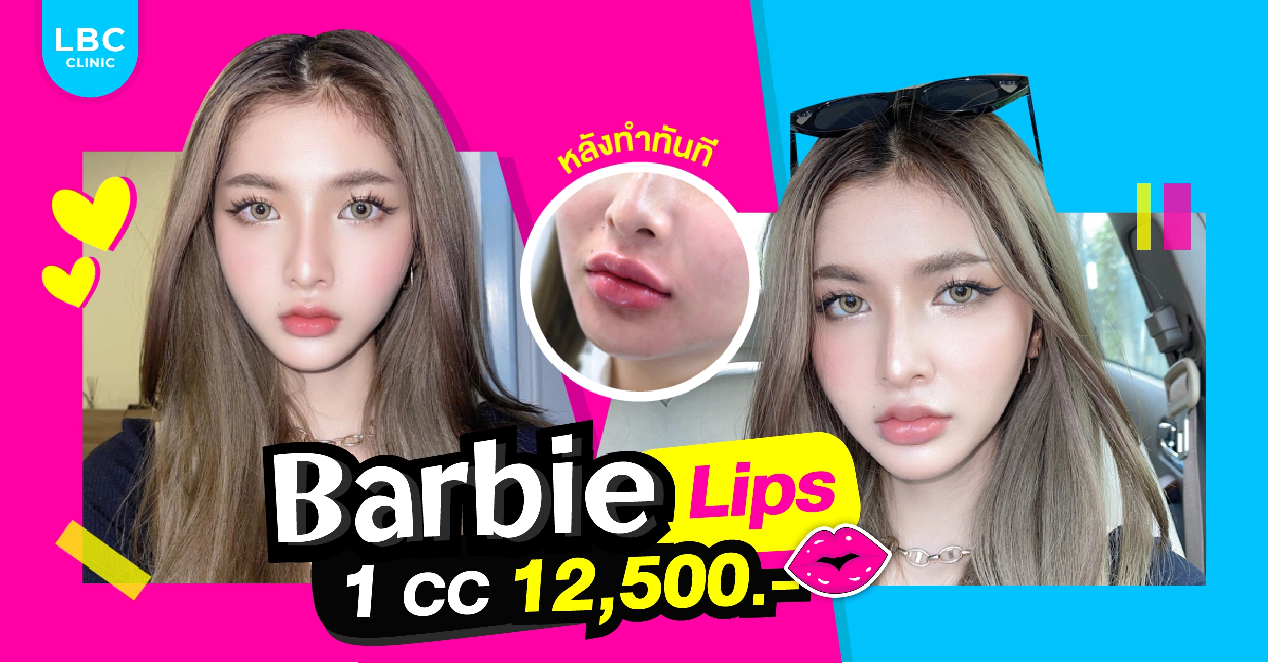Barbie Lips ที่ LBC Clinic