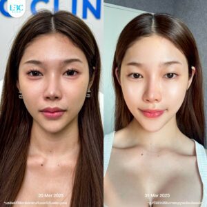 LBC แอลบีซี - ดูแลผิวหน้าใส