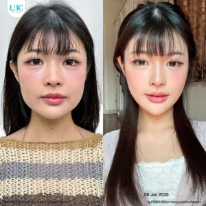 LBC แอลบีซี BT