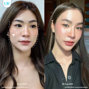LBC แอลบีซี BT