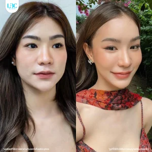 LBC แอลบีซี BT