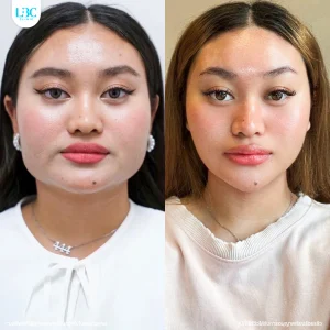 LBC แอลบีซี BT
