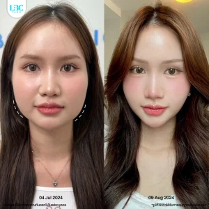 LBC แอลบีซี BT