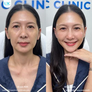 แอลบีซี LBC - Filler ฟิลเลอร์