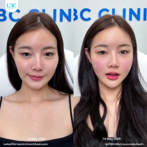 แอลบีซี LBC - Filler ฟิลเลอร์