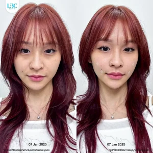 แอลบีซี LBC - Filler ฟิลเลอร์