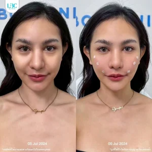 แอลบีซี LBC - Filler ฟิลเลอร์