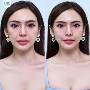 แอลบีซี LBC - Filler ฟิลเลอร์