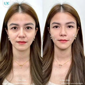 แอลบีซี LBC - Filler ฟิลเลอร์