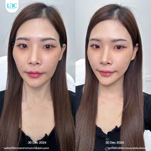 LBC แอลบีซี - ฟิลเลอร์ Filler ราคาดี ปลอดภัย14