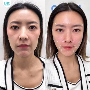แอลบีซี LBC - Filler ฟิลเลอร์