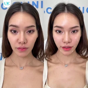 แอลบีซี LBC - Filler ฟิลเลอร์