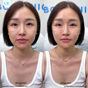 แอลบีซี LBC - Filler ฟิลเลอร์