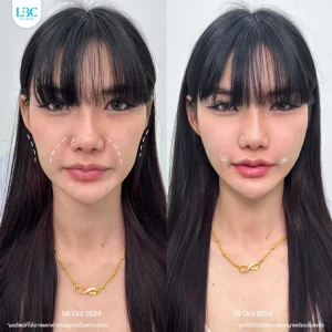 แอลบีซี LBC - Filler ฟิลเลอร์