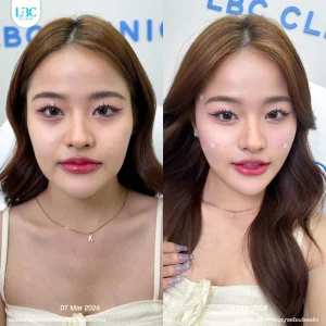 แอลบีซี LBC - Filler ฟิลเลอร์