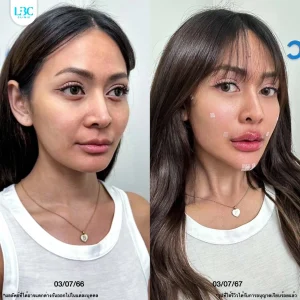 แอลบีซี LBC - Filler ฟิลเลอร์