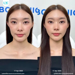 แอลบีซี LBC - Filler ฟิลเลอร์