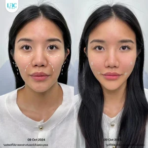 แอลบีซี LBC - Filler ฟิลเลอร์