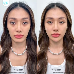 แอลบีซี LBC - Filler ฟิลเลอร์