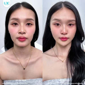 แอลบีซี LBC - Filler ฟิลเลอร์