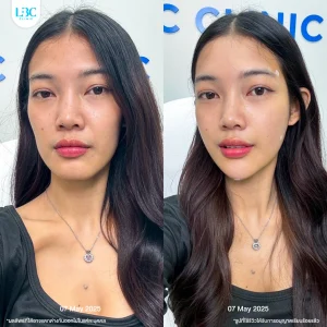 แอลบีซี LBC - Filler ฟิลเลอร์