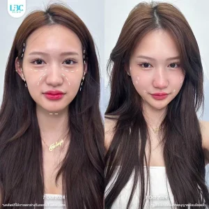 แอลบีซี LBC - Filler ฟิลเลอร์