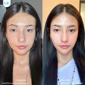 LBC แอลบีซี ยกกระชับ รีวิวจริง