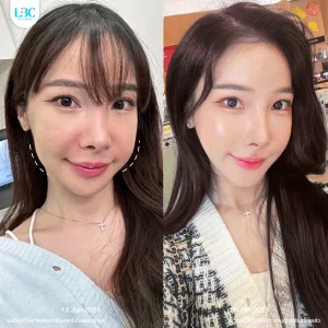 LBC แอลบีซี ยกกระชับ รีวิวจริง