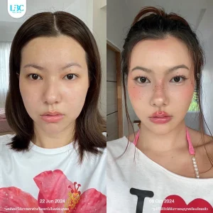 LBC แอลบีซี ยกกระชับ รีวิวจริง