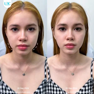 LBC แอลบีซี ยกกระชับ รีวิวจริง