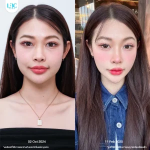 LBC แอลบีซี ยกกระชับ รีวิวจริง