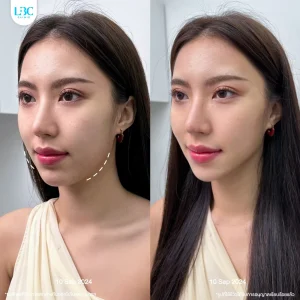 LBC แอลบีซี ยกกระชับ รีวิวจริง