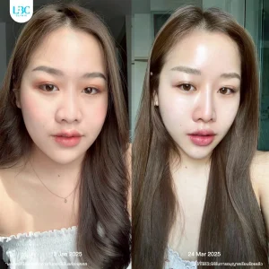 LBC แอลบีซี ยกกระชับ รีวิวจริง