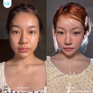 LBC แอลบีซี ยกกระชับ รีวิวจริง