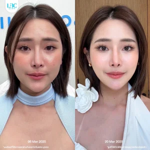 LBC แอลบีซี ยกกระชับ รีวิวจริง18