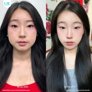 LBC แอลบีซี ยกกระชับ รีวิวจริง