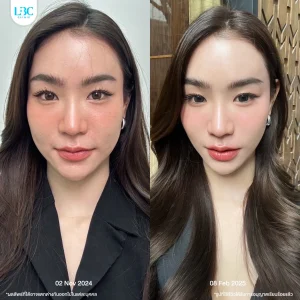 LBC แอลบีซี ยกกระชับ รีวิวจริง