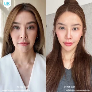 LBC แอลบีซี ยกกระชับ รีวิวจริง