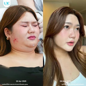LBC แอลบีซี รีวิวจริง