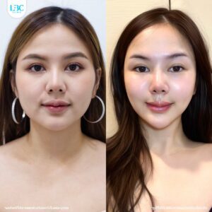 LBC แอลบีซี - ดูแลผิวหน้าใส