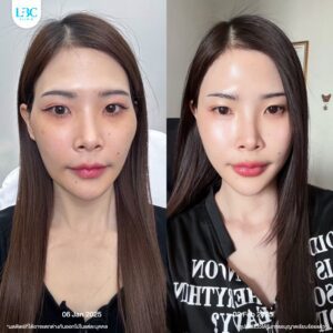 LBC แอลบีซี - ดูแลผิวหน้าใส