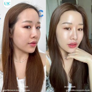 LBC แอลบีซี - ดูแลผิวหน้าใส