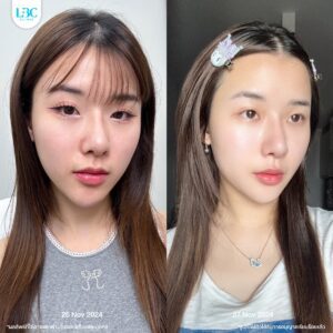 LBC แอลบีซี - ดูแลผิวหน้าใส