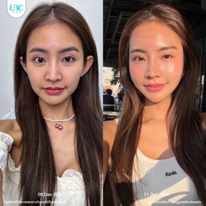LBC แอลบีซี - ดูแลผิวหน้าใส