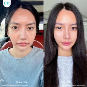 LBC แอลบีซี - ดูแลผิวหน้าใส