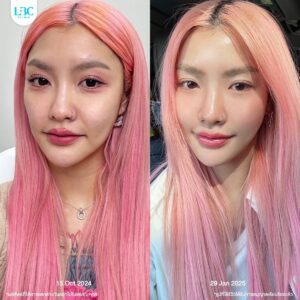 LBC แอลบีซี - ดูแลผิวหน้าใส