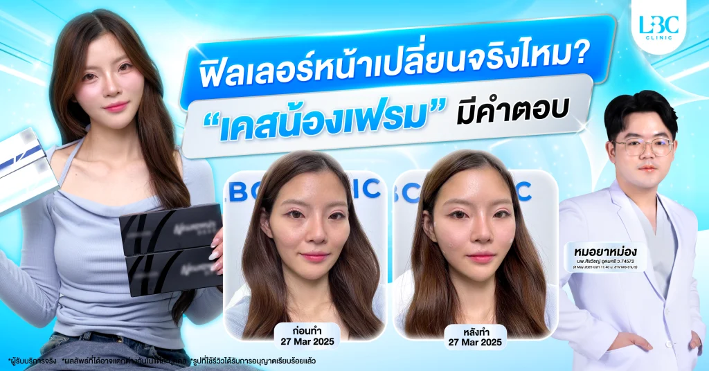 รีวิวฟิลเลอร์6cc LBC